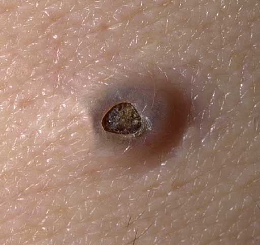 Blackheads, Black Head Clusters and Nevus Comedonicus ...